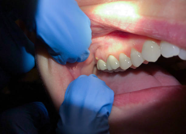 Best Emergency Wisdom Teeth Removal in Mullins, SC